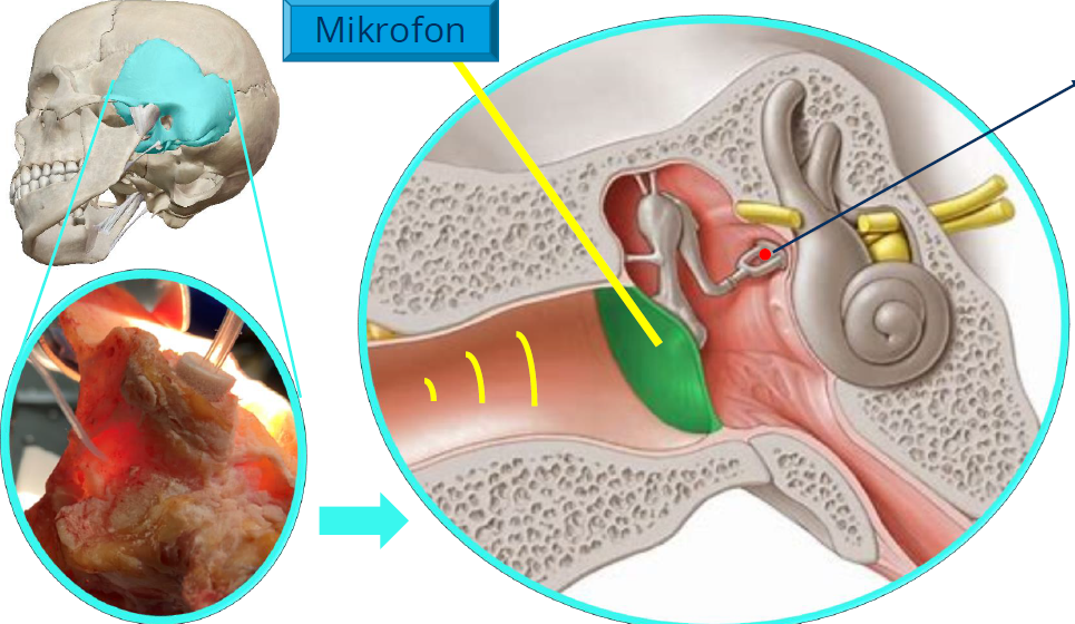 Bioengineered Eardrum Scaffold